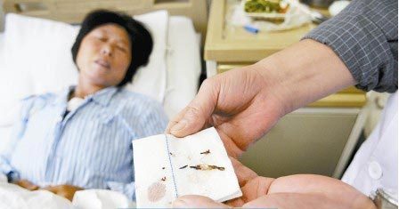 通過(guò)手術(shù)取出的針?！　∩虉?bào)記者 