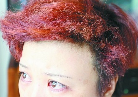 張女士的頭發(fā)、眉毛被燒。