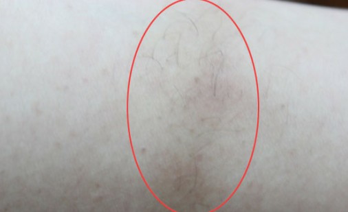 消費(fèi)者噴云南白藥長(zhǎng)黑毛頻現(xiàn) 廠家稱功效明確