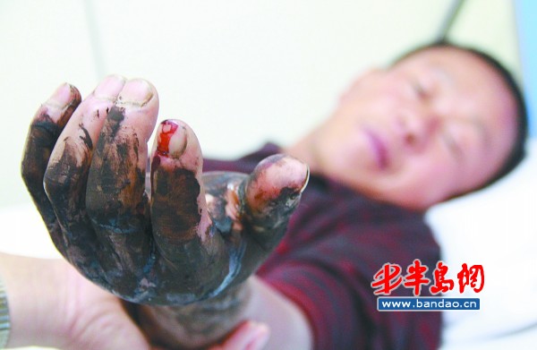 鄒先生的左手被蛇咬傷后明顯腫脹。