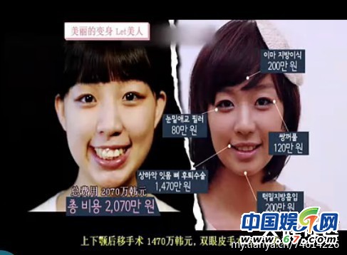 多圖劇透韓國整容節(jié)目《LET 美人》近幾期，最愛小V臉，人瘦就能美
