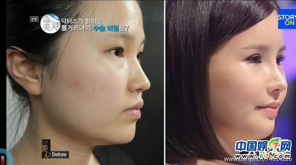 多圖劇透韓國整容節(jié)目《LET 美人》近幾期，最愛小V臉，人瘦就能美