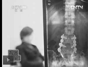 圖1：教練按壓導(dǎo)致學(xué)員腰椎間盤突出。（央視截屏）