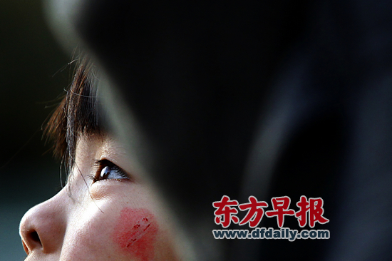 昨日，復(fù)旦大學(xué)附屬兒科醫(yī)院，7歲女童若若（化名）左邊臉頰還留有被劃破的傷痕。 早報(bào)記者 王辰 圖
