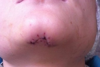 年輕女子被撞毀容 肇事方提醒藥費(fèi)超限不給報