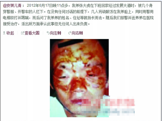 張大虎的姐姐將弟弟面部燒傷一事發(fā)上微博，引發(fā)網(wǎng)友廣泛關注。
